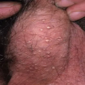 Moszna choroby skórne kaszaki