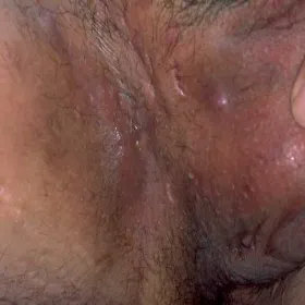 Moszna stan zapalny trądzik odwrócony