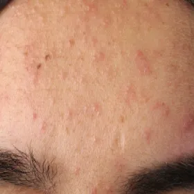 Na czole zapalenie mieszków włosowych