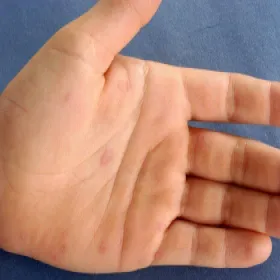 Na dłoni rumień wielopostaciowy 