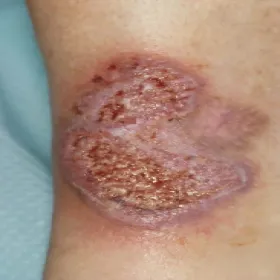 Naciek z lekko czerwonawą obwódką na skórze piodermia zgorzelinowa