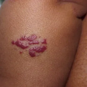 Naczyniak prosty zdjęcie