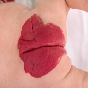 Naczyniak rozgałęziony zdjęcie