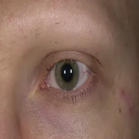 Nadmierna utrata włosów brwi i rzęs łysienie plackowate