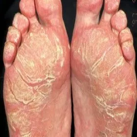 Nadmierne rogowacenie skóry na stopach