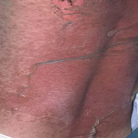 Nadwrażliwość na leki 