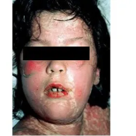 Nadwrażliwość na leki u dzieci 