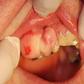 Nadziąślak olbrzymiokomórkowy