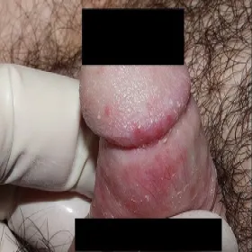 Napletek i żołądź zapalenie napletka zdjęcie