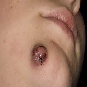 Narośl guzek pod brodą ziarniniak