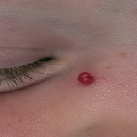 Narośl koło oka ziarniniak