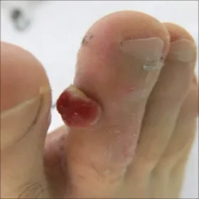 Narośl między palcami u stóp