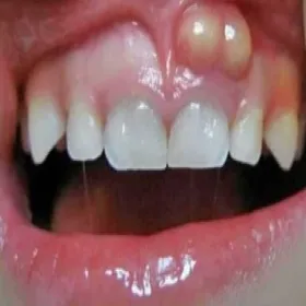 Narośl na dziąśle nadziąślak 