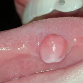 Narośl na języku ziarniniak naczyniowy