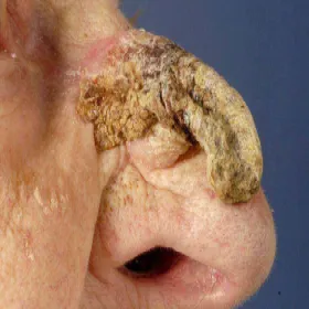 Narośl na nosie róg skórny