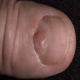 Narośl na paznokciu 