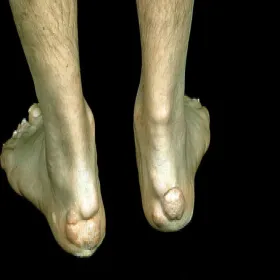 Narośl na pięcie kępki żółte guzkowe 