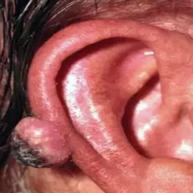 Narośl na uchu rogowiak kolczystokomórkowy 