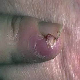 Narośl z boku paznokcia