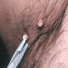 Narośla na skórze pod pachą włókniaki