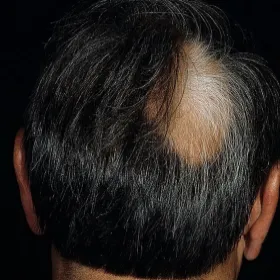 Nerwica wypadanie włosów łysienie plackowate 