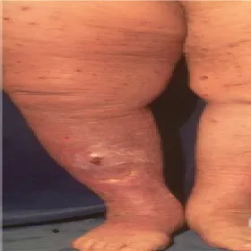 Niebezpieczne zmiany skórne wyprysk podudzi 