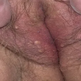 Niebolący guzek na wargach sromowych