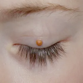 Niebolesny guzek w skórze powieki