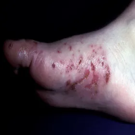 Niedobór cynku objawy zespół Brandta