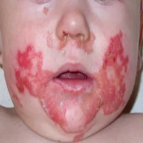 Niedobór cynku u dzieci zespół Danbolta-Clossa