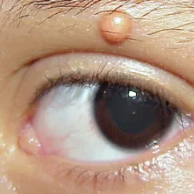 Nieduży guzek nad okiem żółtakoziarniniakowatość młodzieńcza 