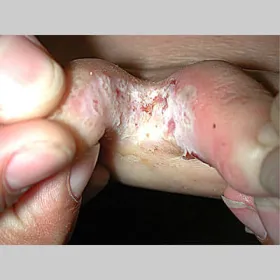 Niegojącą się rana między palcami stopa sportowca 