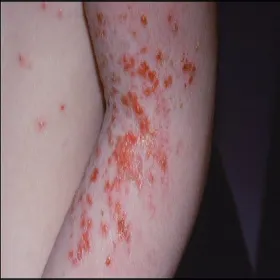 Nieswędząca wysypka u dziecka liszajec zakaźny