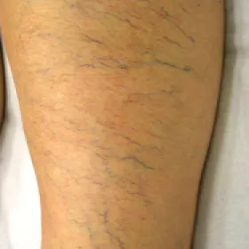 Niewydolność żylna zdjęcia