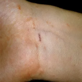 Nory świerzbowcowe u dziecka