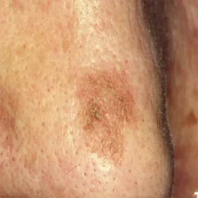 Nos zmiana skórna choroba rogowacenie słoneczne