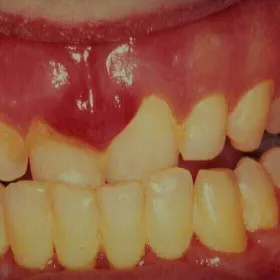 Nowotwór dziąsła mięsak Kaposiego 