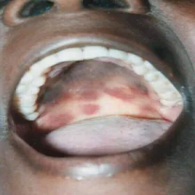 Nowotwór podniebienia mięsak Kaposiego 