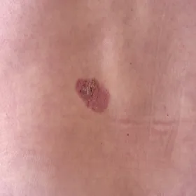 Nowotwór skóry BBC