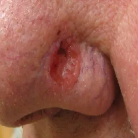 Nowotwór skóry nosa