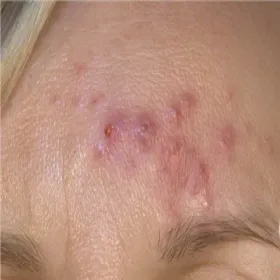 Nużeńce ludzkie na czole nużyca