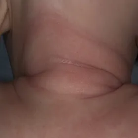 Objawy atopowego atopowe zapalenie skóry u niemowląt