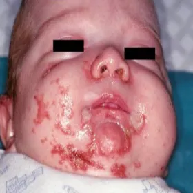 Objawy niedoboru cynku u dzieci zespół Brandta