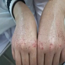 Objawy po noszeniu rękawiczek z lateksu