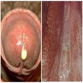 Objawy rzeżączki u mężczyzn i kobiet