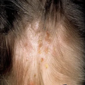 Objawy wszawicy na skórze głowy