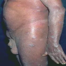 Objawy zespół Sezary’ego 