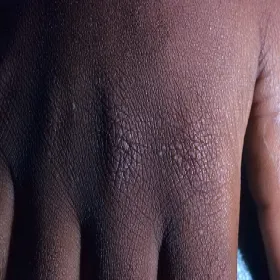 Obraz liszaj lśniący 