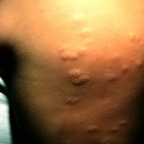 Obrzęk pokrzywkowy na skórze - choroba anetoderma