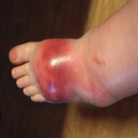 Obrzęk stopy choroba róża